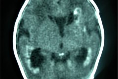 calcificaciones-periventriculare-citomegalovirus-cmv-2001-008
