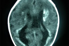calcificaciones-periventriculare-citomegalovirus-cmv-2001-009
