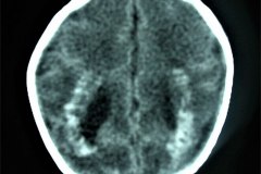 calcificaciones-periventriculare-citomegalovirus-cmv-2001-010