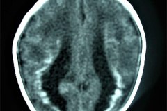 calcificaciones-periventriculare-citomegalovirus-cmv-2001-011