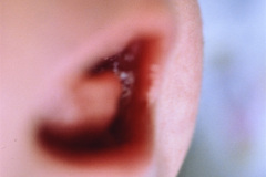 candidiasis-mucosa-oral-000