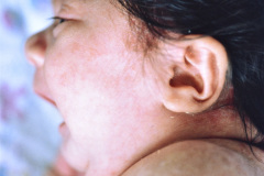 candidiasis-mucosa-oral-001