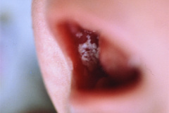 candidiasis-mucosa-oral-002
