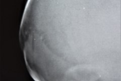 caput-fractura-occipital-1989-000