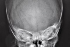 caput-fractura-occipital-1989-001