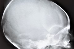 caput-fractura-occipital-1989-002