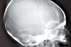 caput-fractura-occipital-1989-003