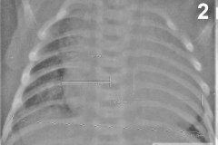 cardiomegalia-indice-cardiotoracico-0.71-2011-000