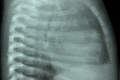 cardiopatia-cianogena-bajo-flujo-pulmonar-cardiomegalia-1982-000