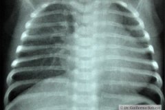 cardiopatia-cianogena-bajo-flujo-pulmonar-cardiomegalia-1982-001
