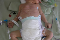 cardiopatia-cianogena-drenaje-venoso-anomalo-cia-civ-atresia-pulmonar-cabalgamiento-aorta-2004-004