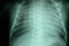 cardiopatia-coao-vu-tgv-cia-2m-20d-2005-000