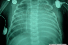 cardiopatia-coao-vu-tgv-cia-2m-20d-2005-001