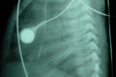 cardiopatia-coao-vu-tgv-cia-2m-20d-2005-002
