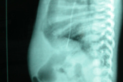 cardiopatia-coao-vu-tgv-cia-2m-20d-2005-003