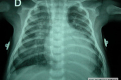 cardiopatia-coao-vu-tgv-cia-2m-20d-2005-005