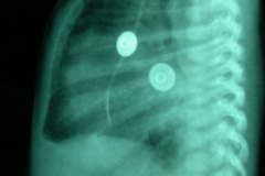 cardiopatia-coao-vu-tgv-cia-2m-20d-2005-006