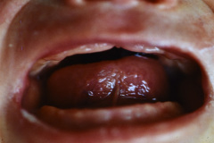 carpenter-acrocefalopolisindactilia-tipo-ii-1988-004