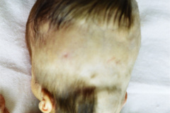 carpenter-acrocefalopolisindactilia-tipo-ii-1988-014