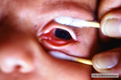 catarata-congenita-puntiforme-bilateral-1988-003