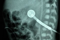 cateter-arterial-umbilical-2005-001