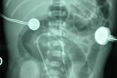 cateter-arterial-umbilical-000