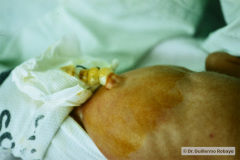 cateter-arterial-umbilical-colocacion1992-000