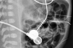 cateter-arterial-umbilical-venoso-femoral-der-2006-000