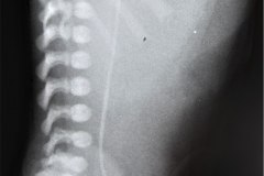 cateter-arterial-umbilical-y-venoso-femoral-der-ascitis-1996-000