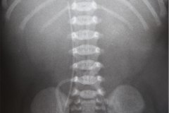 cateter-arterial-umbilical-y-venoso-femoral-der-ascitis-1996-001