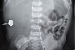 cateter-arterial-umbilical-y-venoso-femoral-izq-2005-001