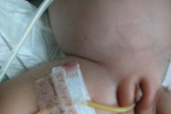cateter-dialisis-peritoneal-y-sonda-vesical-000