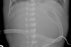 cateter-dialisis-y-arterial-umbilical-sondas-vesical-u-orogastrica-ascitis-2009-000