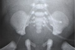 cateter-venoso-femoral-der-en-silla-de-montar-1996-000