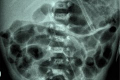 cateter-venoso-femoral-izq-2004-000
