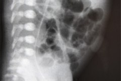 cateter-venoso-femoral-izq-000