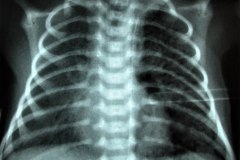 cateter-venoso-femoral-sobreinsertado-y-corregido-001
