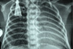 cateter-venoso-yugular-der-bilumen-hipertension-pulmonar-2006-001