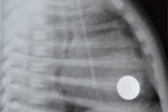 cateter-venoso-yugular-der-cisuritis-taquipnea-transitoria-2003-001