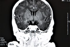 cavum-septum-pellucidum-vergae-y-velum-interpositum-rnm-1997-000