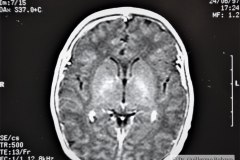 cavum-septum-pellucidum-vergae-y-velum-interpositum-rnm-1997-002