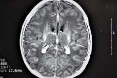 cavum-septum-pellucidum-vergae-y-velum-interpositum-rnm-1997-007