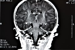 cavum-septum-pellucidum-vergae-y-velum-interpositum-rnm-1997-014