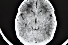 cavun-septum-vergae-pellucidum-tac-000