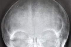 cefalohematoma-parietal-bil-1984-002