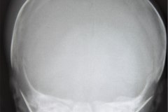 cefalohematoma-parietal-der-1990-000