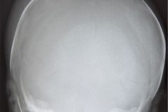 cefalohematoma-parietal-der-1990-001