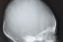 cefalohematoma-parietal-der-1990-002