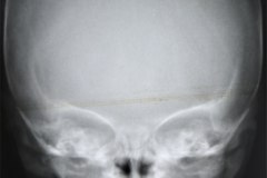 cefalohematoma-parietal-der-1991-002