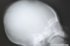 cefalohematoma-parietal-der-1991-003